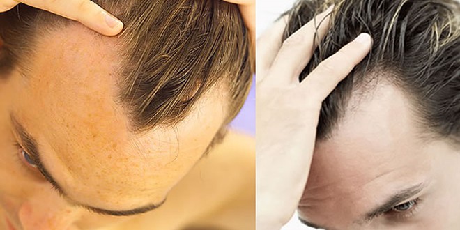 Men’s Grooming – Handling Hair Loss